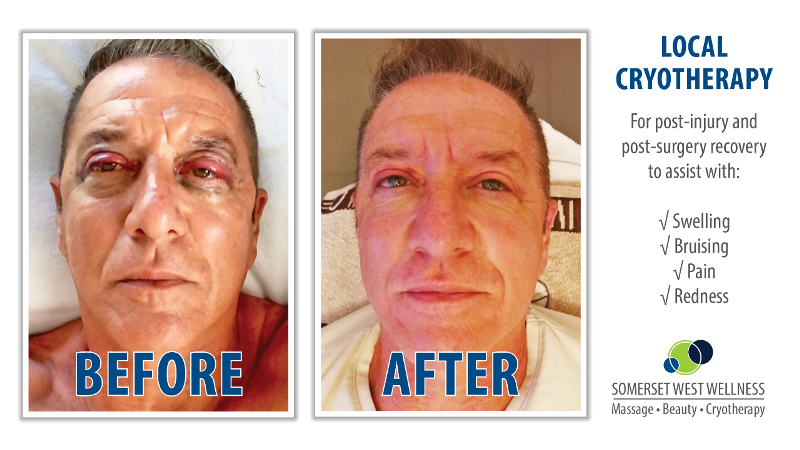 Cryotherapy Before & After Blepharoplasty Surgery